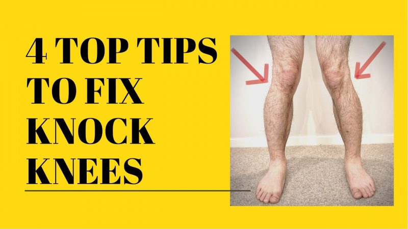 Get Rid Of Genu Valgum By Exercises For Knock Knee Correction