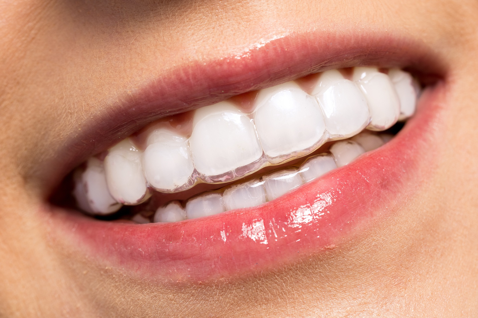 Understanding The Cost Of Dental Aligners: What You Need to Budget For